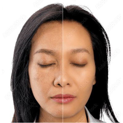 pigmentation